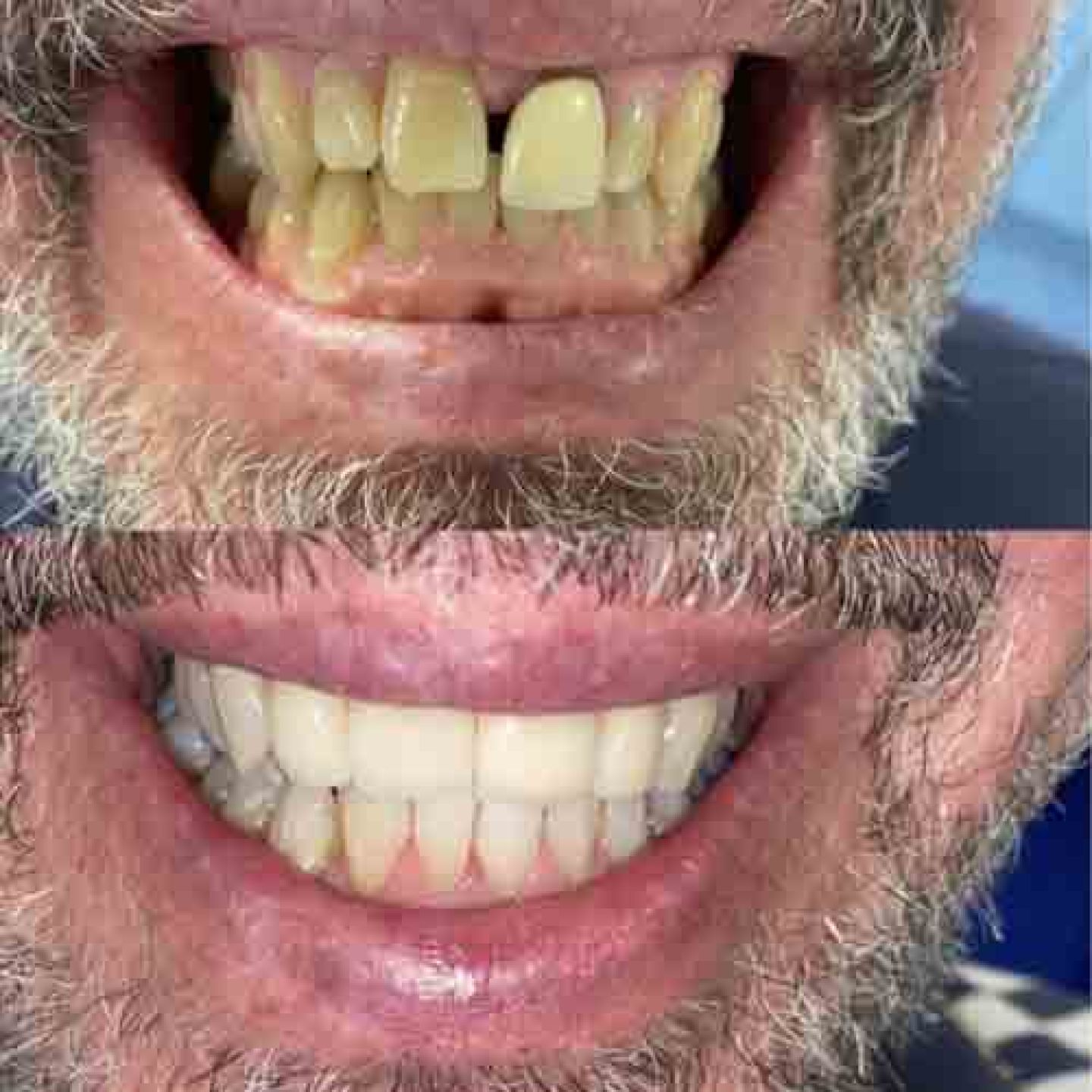 Teeth Straightening Teeth Straightening